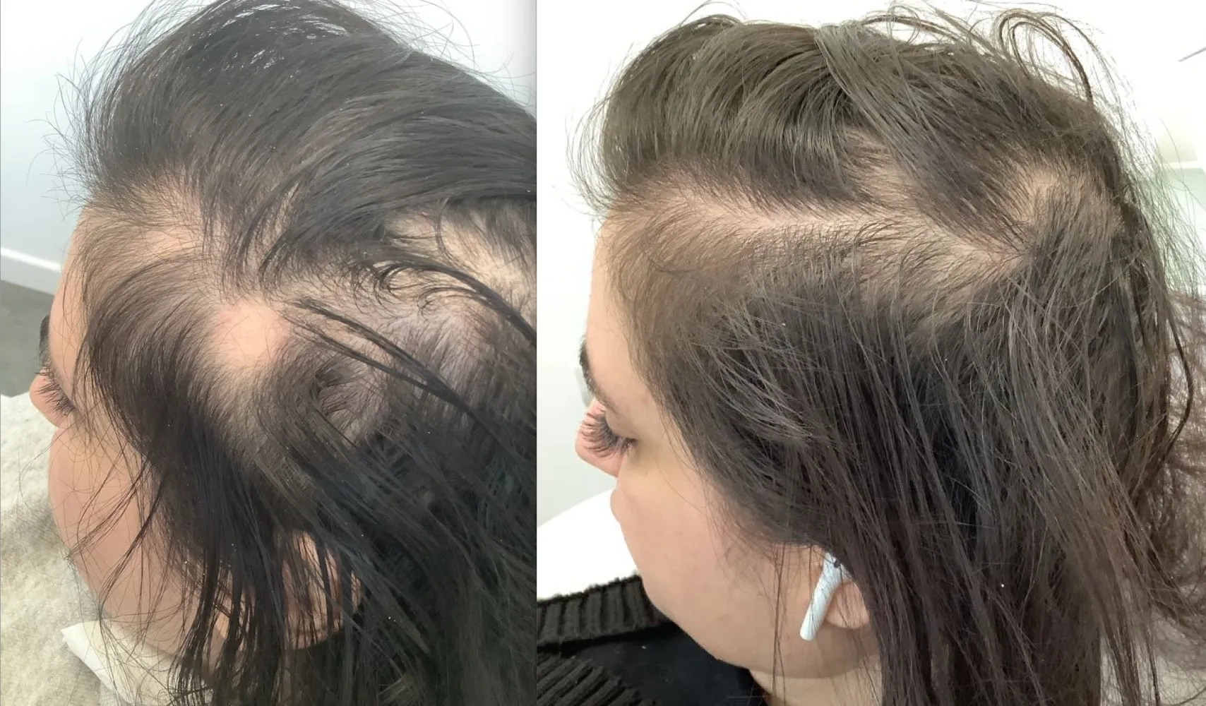 Alopecia Areata Removal Results