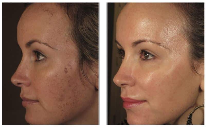 Laser Toning Results