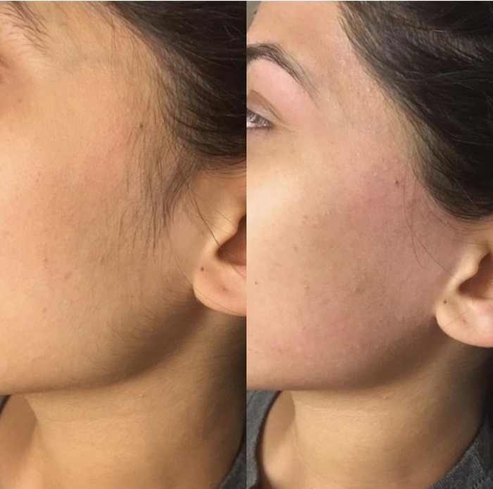 laser hair Removal Results