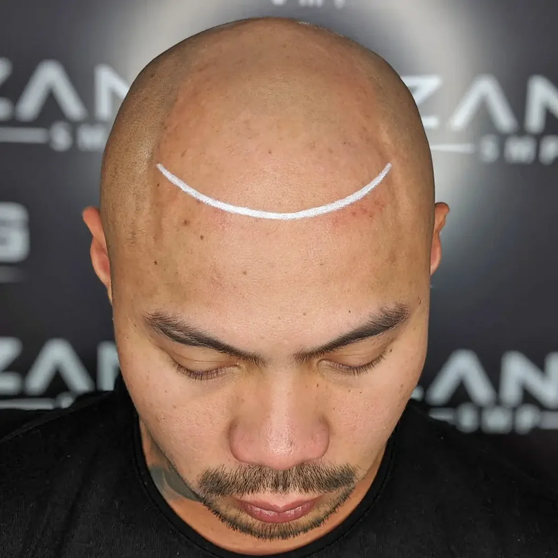 MicroPigmentation Solution