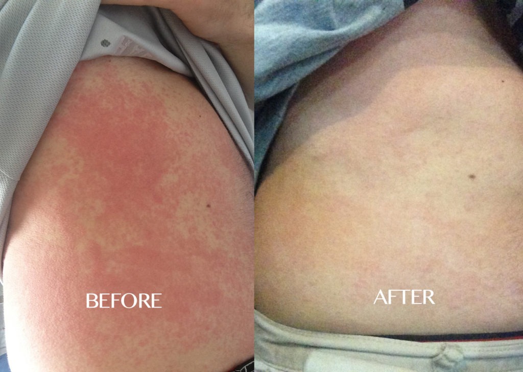 Urticaria Treatment Results