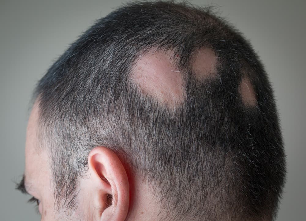 Alopecia Areata Illustration