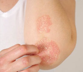 Autoimmune Skin Diseases