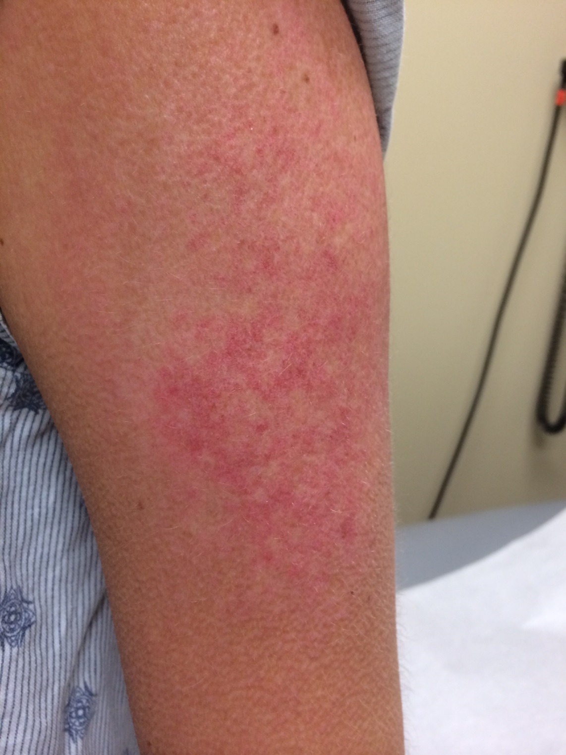 wartremoval Solution