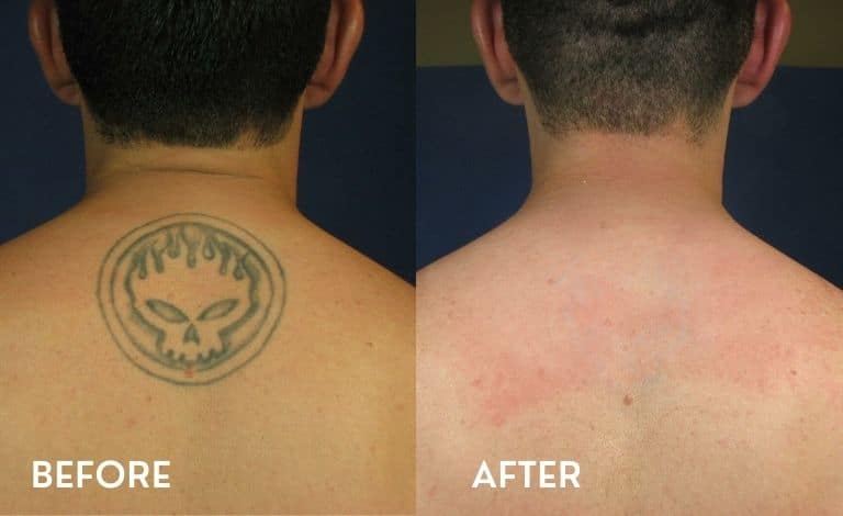 Tattoo removal Results