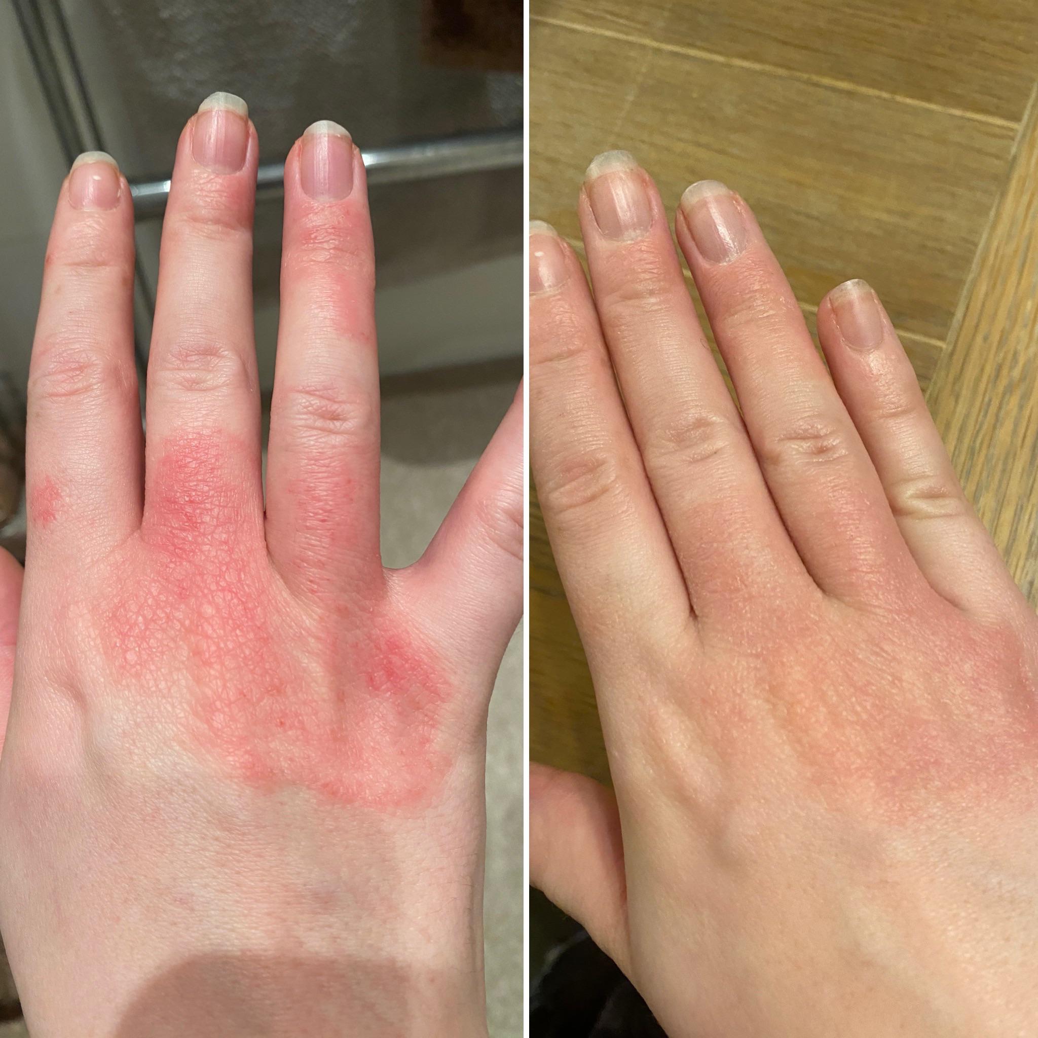 Eczema Treatment Results