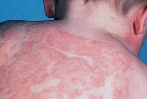 Eczema