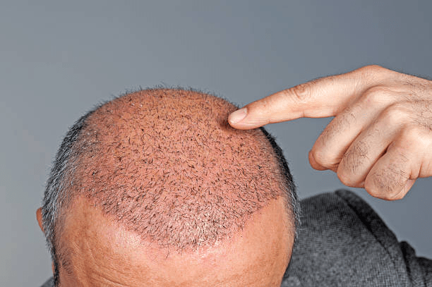 Hair Transplantation