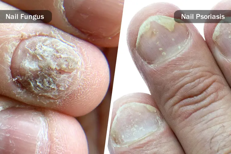 Nail Disease Treatment