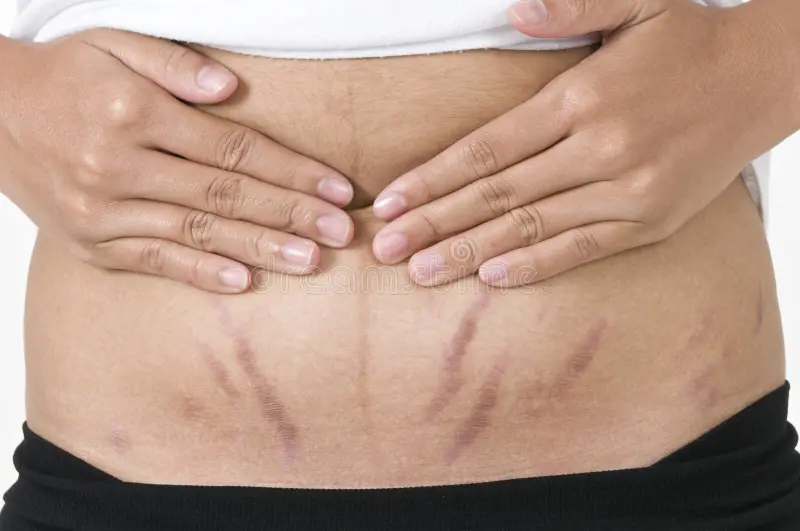 Stretch Marks Treatment