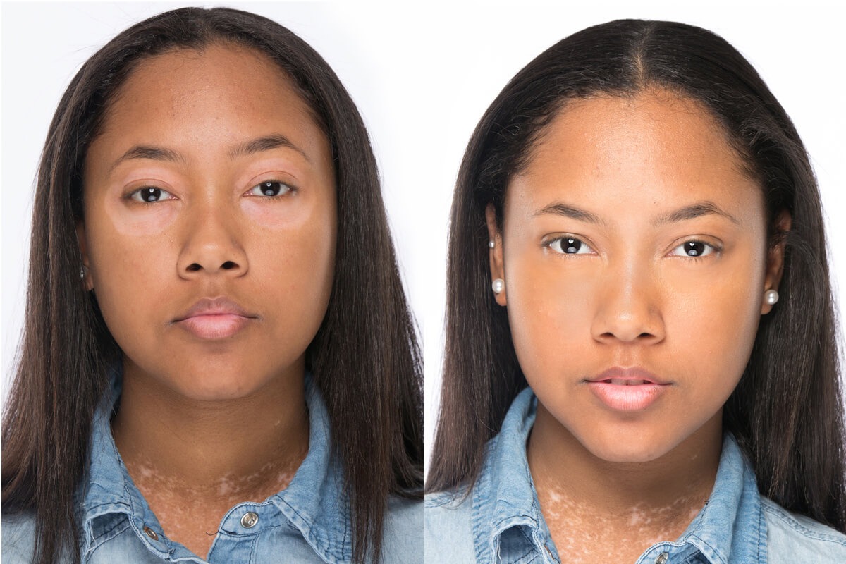 Vitiligo Before After Results