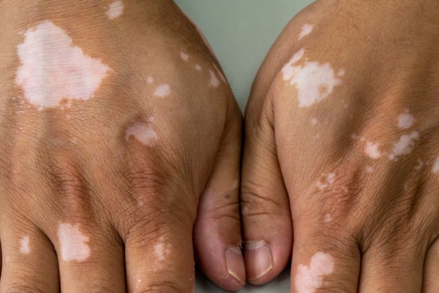 Vitiligo