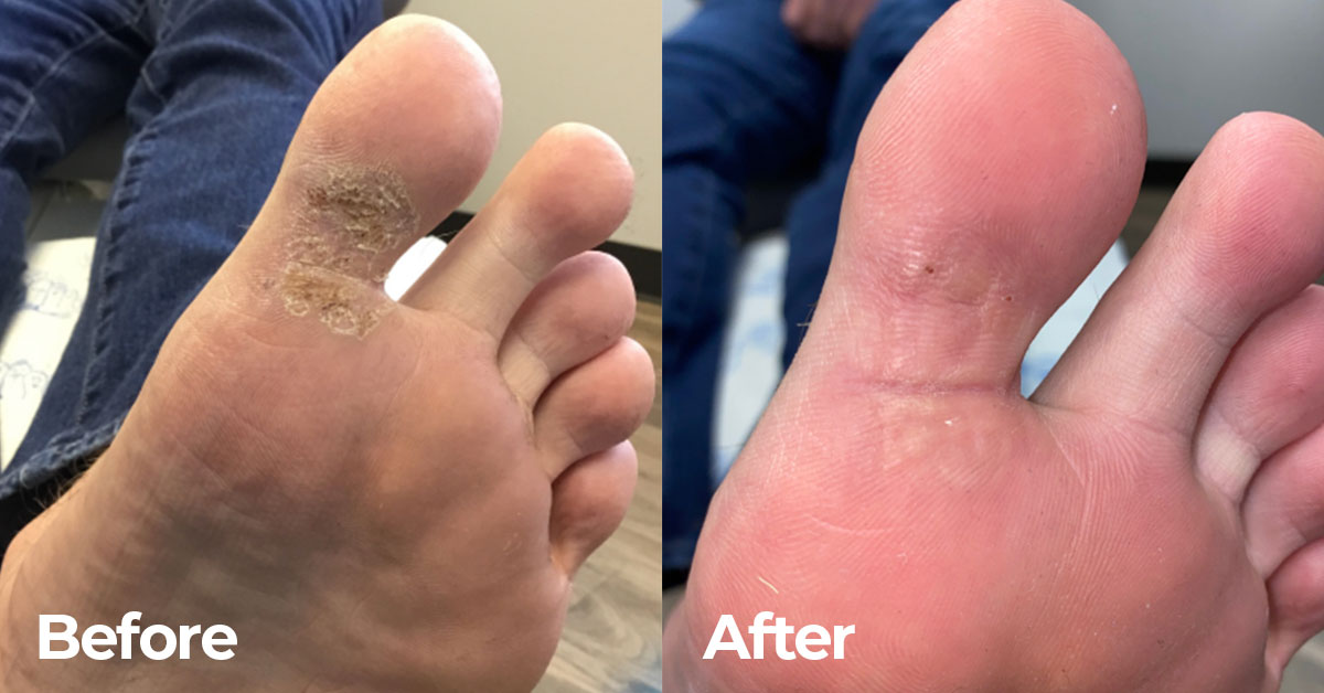 Wart Removal Results