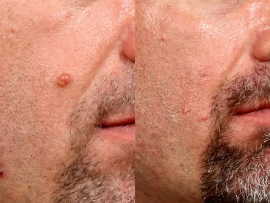 cyst removal Treatment Results