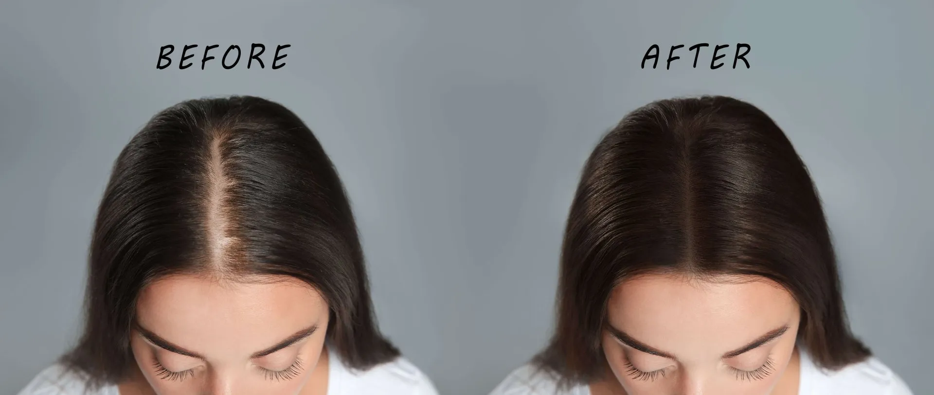 Hair Mesotherapy Results