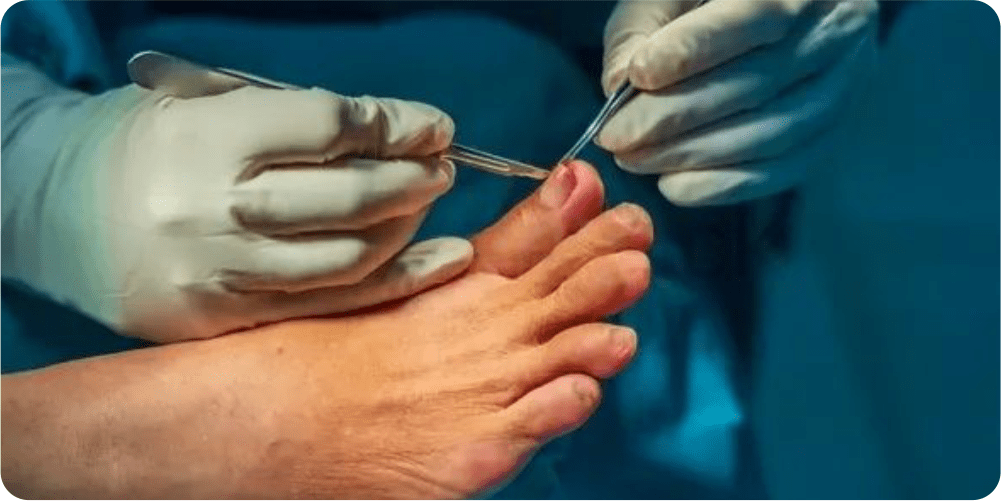 nailsurgery Treatment