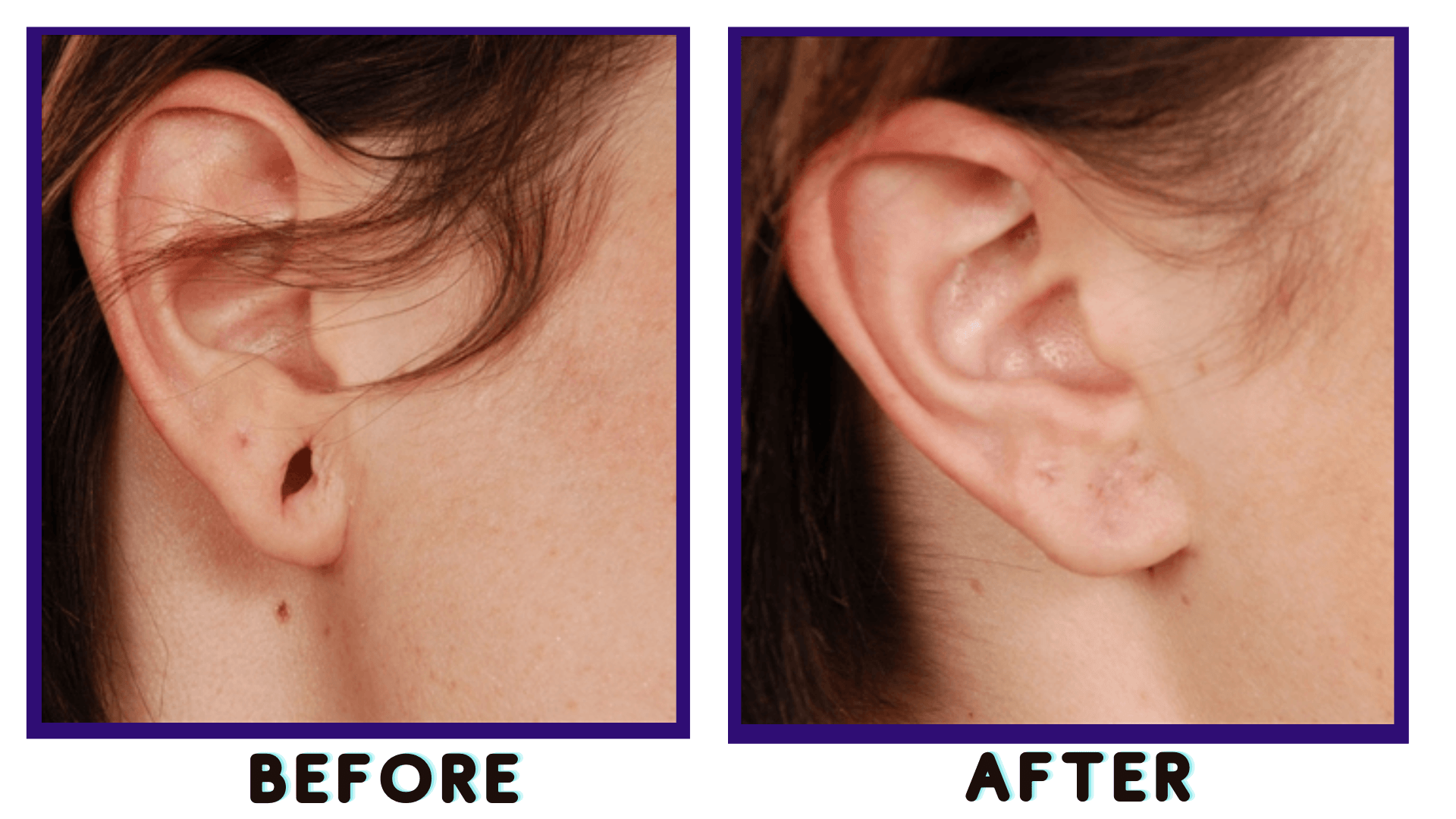 earlobe Treatment Results