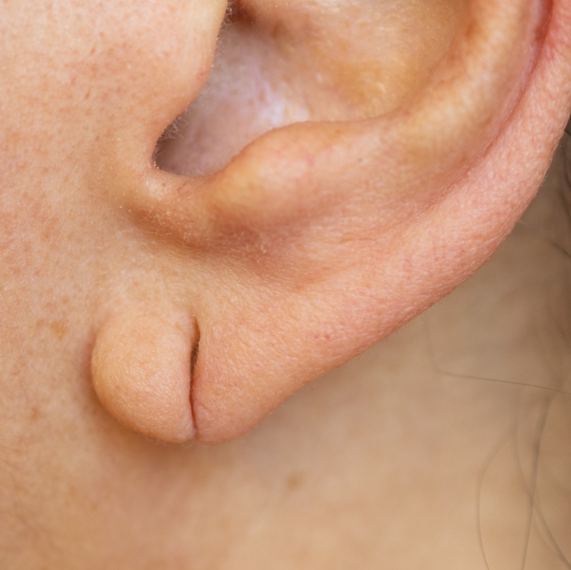 Earlobe Repair treatment