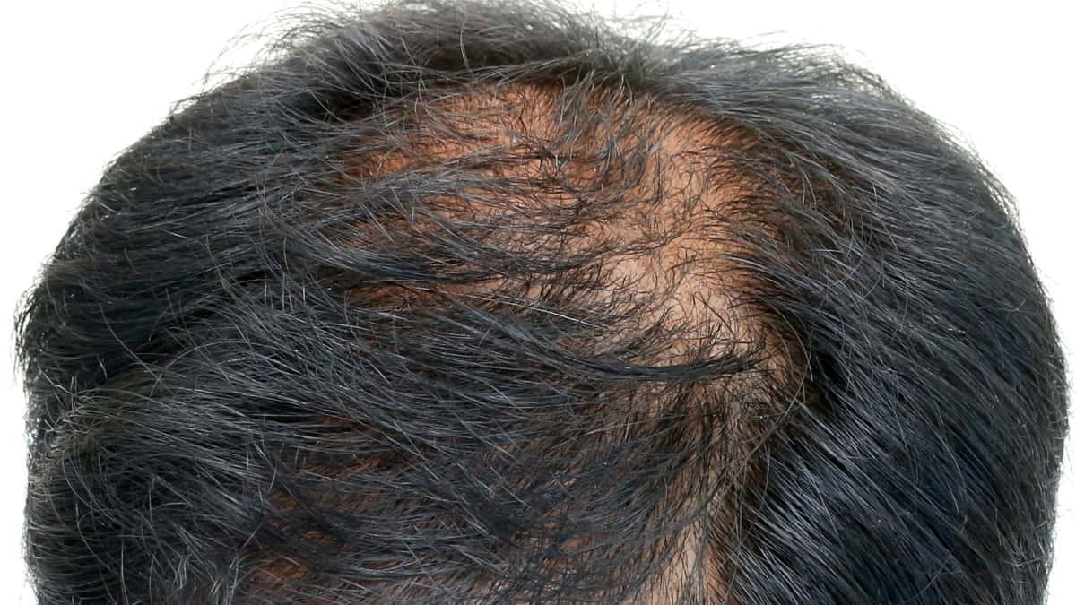 Hair loss treatment