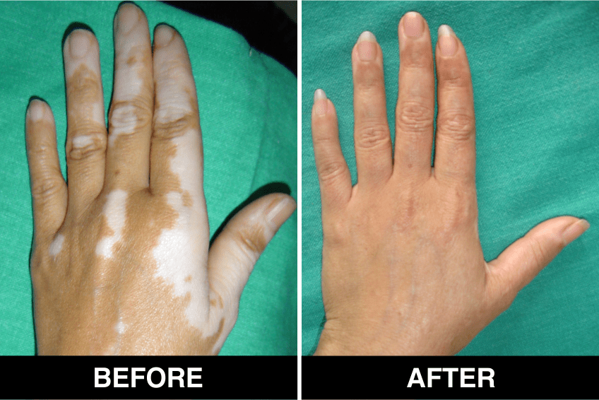 vitiligo Results