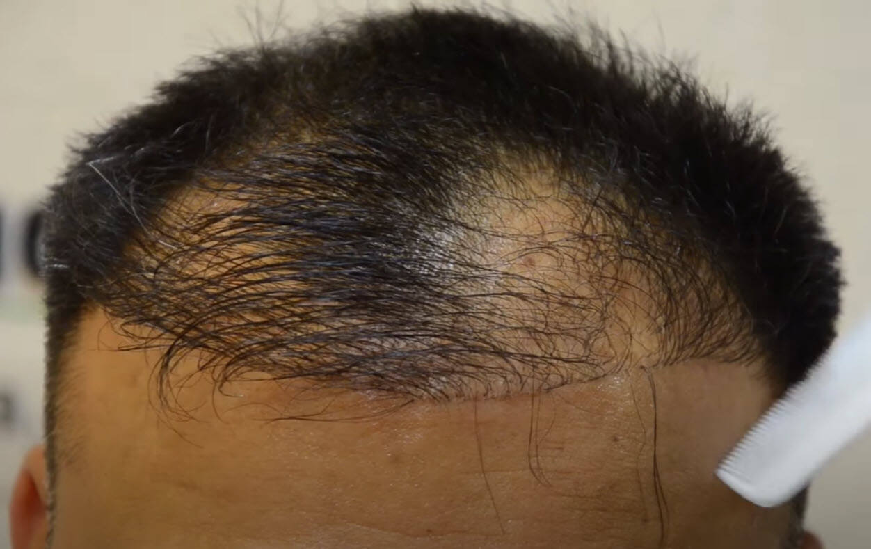 Hair Transplant treatment