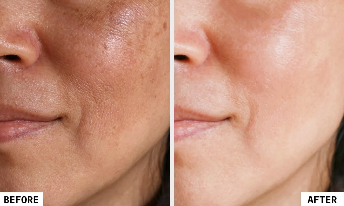 pEEL Removal Results