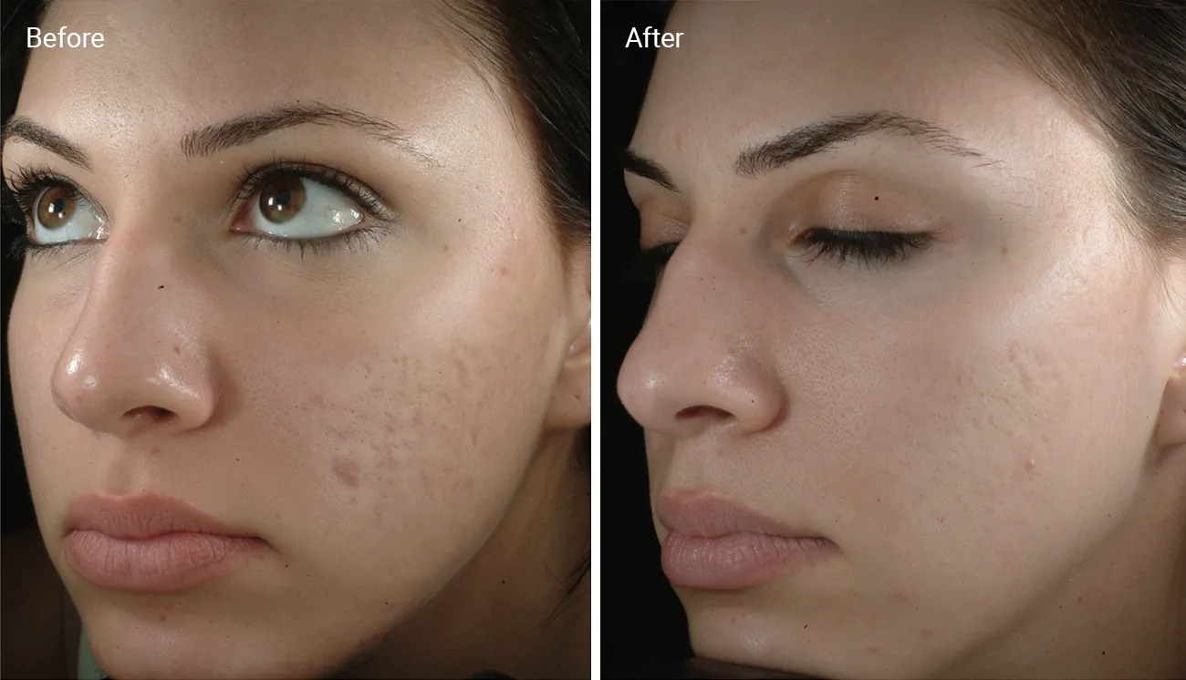 Acne Removal Results