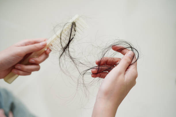 Excess Hair Fall