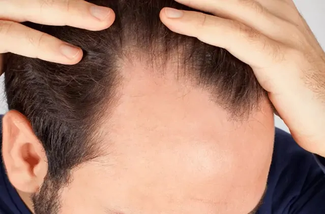 Hair Loss Due to Stress