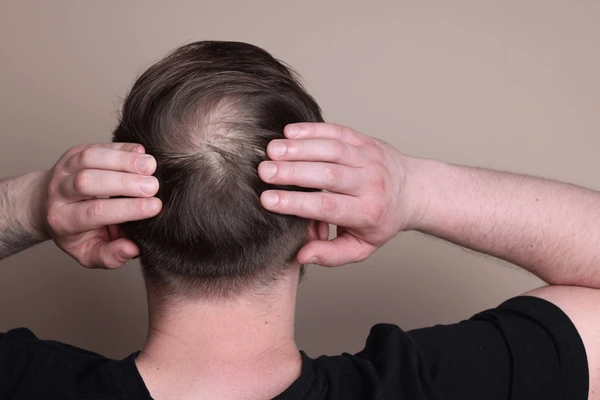 Hair Thinning